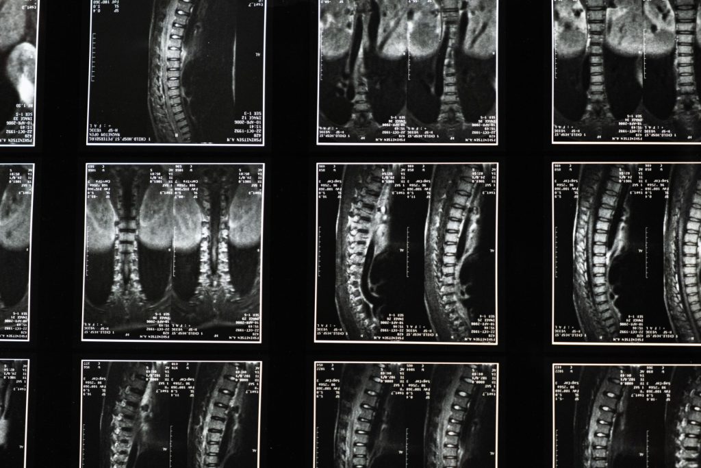 Grid of black-and-white spinal MRI slices with sagittal and coronal views and edge measurements.