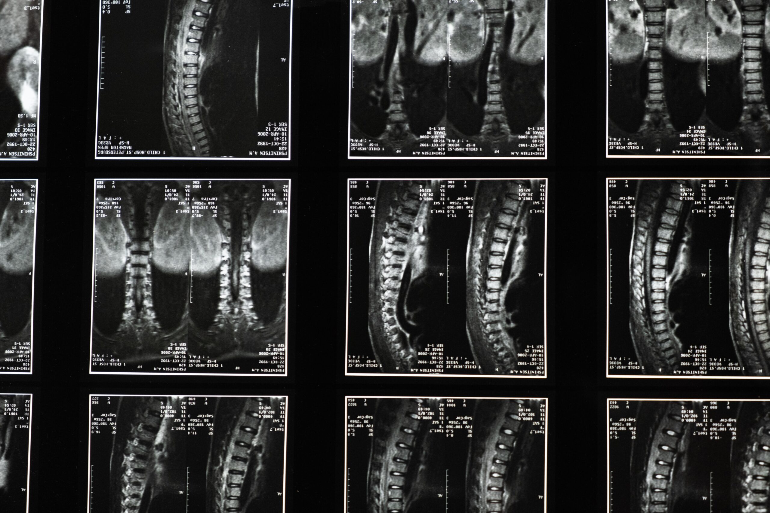 Grid of black-and-white spinal MRI slices with sagittal and coronal views and edge measurements.