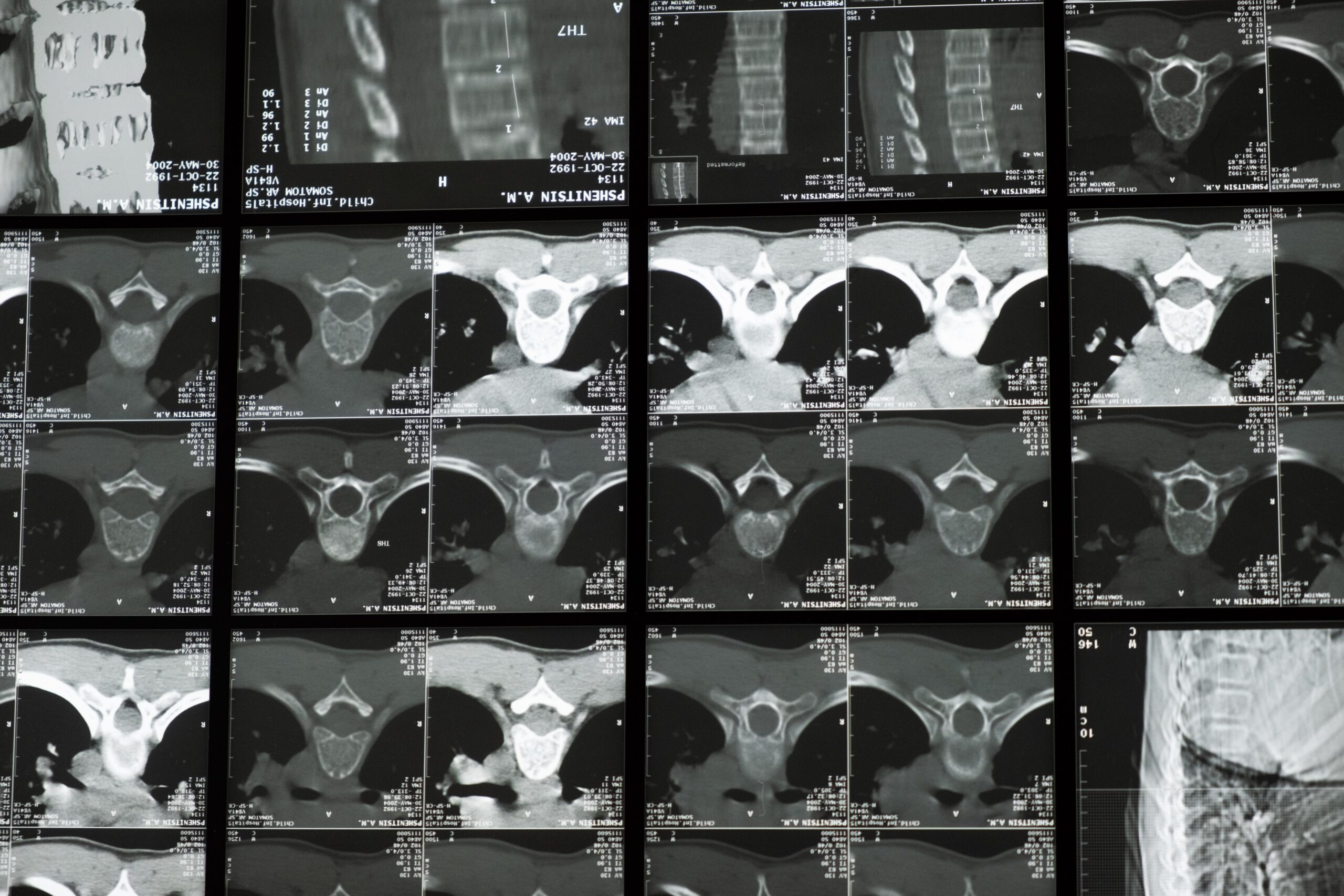 Grid of axial spine CT/MRI slices showing thoracic to lumbar vertebrae and surrounding tissues.